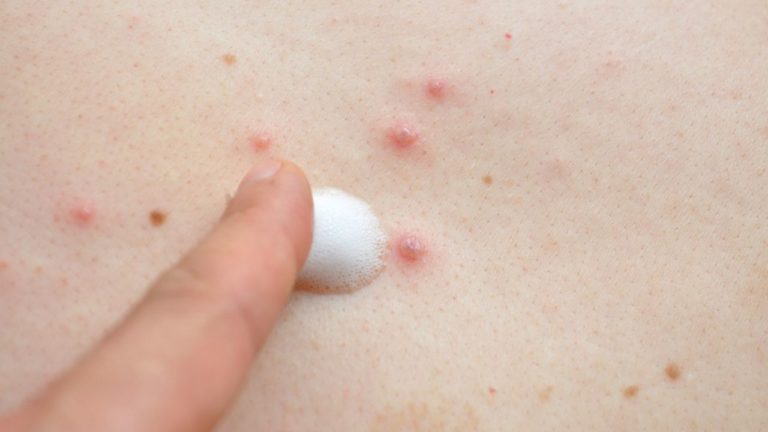 OMS cambia el nombre de viruela del mono a mpox