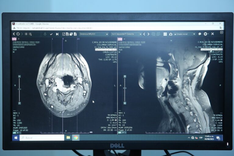 Especialistas del Issste salvan de daño medular y riesgo cerebral irreversible a joven con raro tumor
