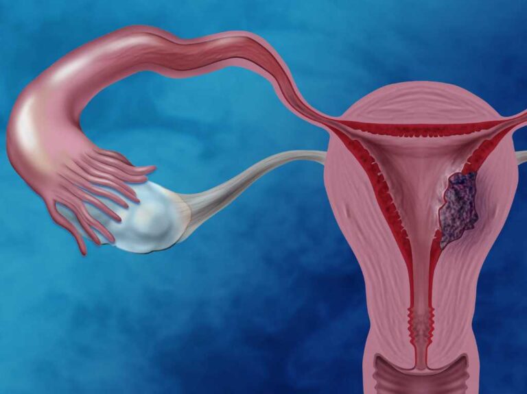 Prevén futuro alentador en terapias para cáncer de endometrio
