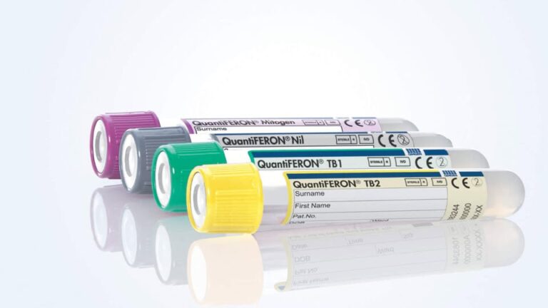 Necesario, fortalecer la detección oportuna de la tuberculosis latente Necesario, fortalecer la detección oportuna de la tuberculosis latente