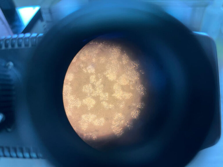 La fibrosis hepática puede revertirse, pero la cirrosis ya no: Isabel Méndez