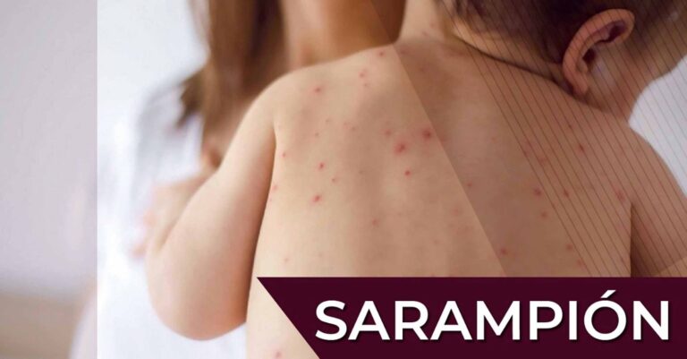 Sarampión, más contagioso que la COVID-19: UNAM