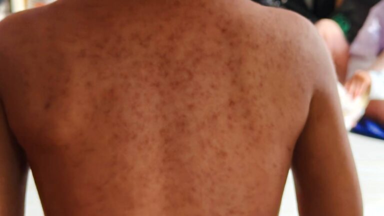 CDMX informa sobre alcaldías con más casos de sarampión y llama a no “estigmatizar”