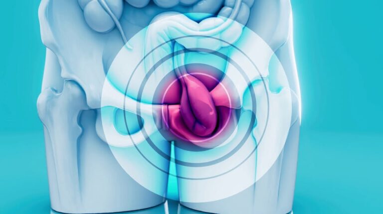 Ignorar sangre en la orina puede costar vidas: alertan sobre diagnóstico tardío de cáncer de vejiga