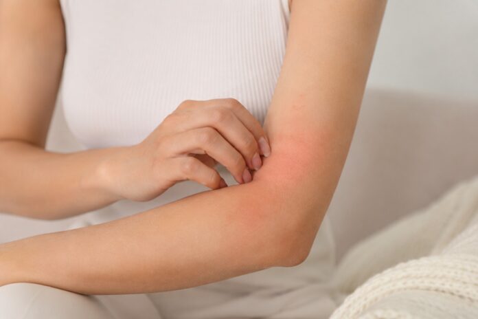 Dermatitis atópica afecta a más del 10% de la población en México y va más allá de la piel